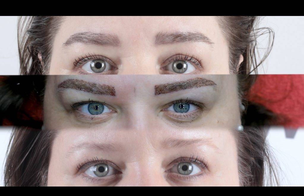 micro brow implant nedir JEsDbZyM